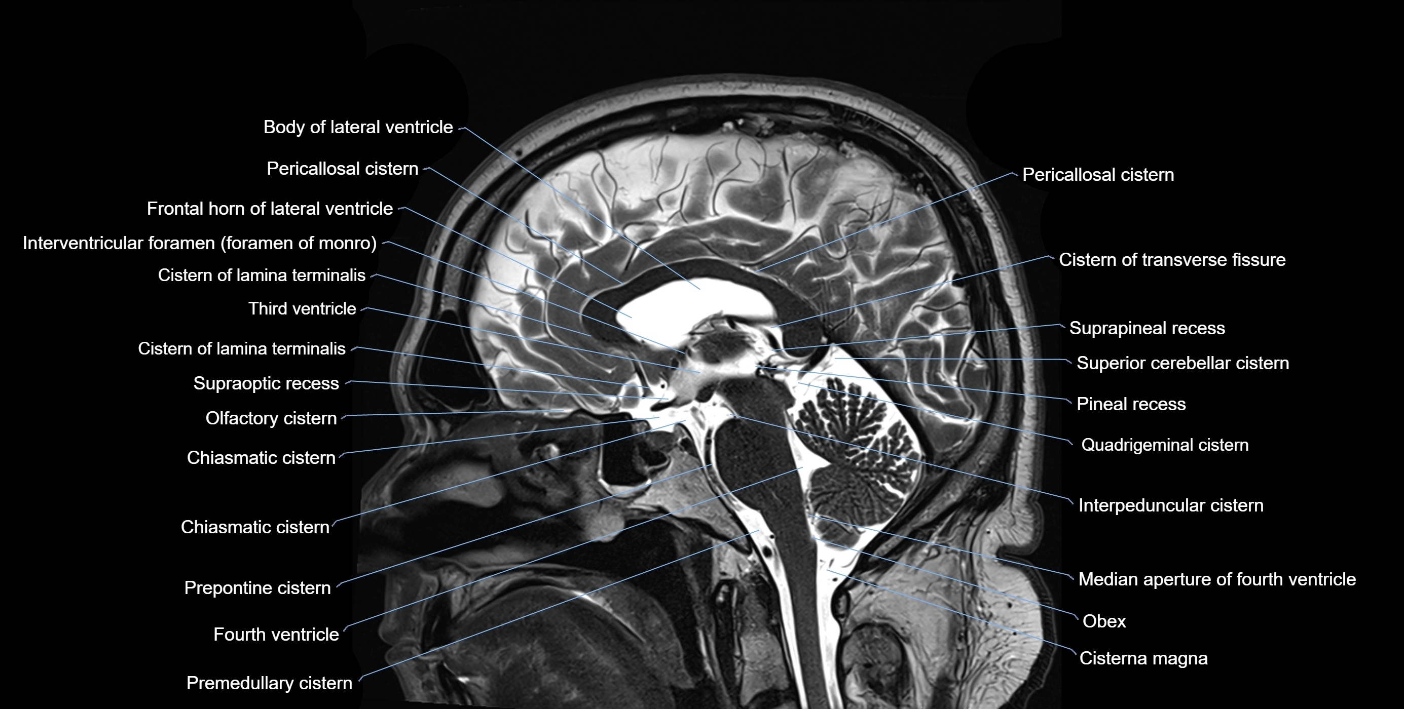Brain cisterns  and ventricles sagittal anatomy 3T MRI image-img-00001-00030.webp
